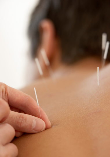 acupuncture 2